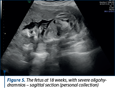 Figure 5. The fetus at 18 weeks, with severe oligohy­dramnios – sagittal section (personal collection)