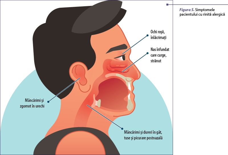 Figura 5. Simptomele pacientului cu rinită alergică