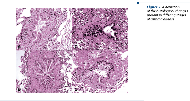 Figure 2. A depiction of the histological changes present in differing stages of asthma disease