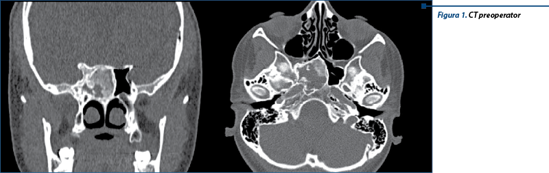 Figura 1. CT preoperator