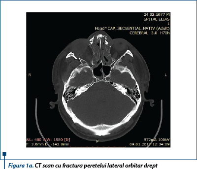 Figura 1a. CT scan cu fractura peretelui lateral orbitar drept