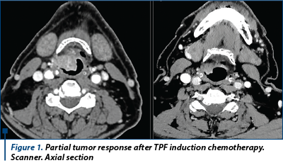 Figure 1. Partial tumor response after TPF induction chemotherapy. Scanner. Axial section