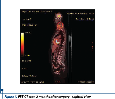 Figure 7. PET-CT scan 2 months after surgery - sagittal view