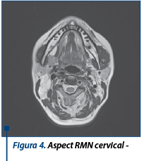 Figura 4. Aspect RMN cervical - secțiune transversală