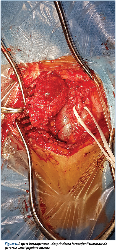 Figura 6. Aspect intraoperator - desprinderea formațiunii tumorale de peretele venei jugulare interne