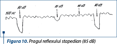 Figura 10. Pragul reflexului stapedian (85 dB)