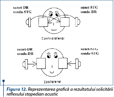 Figura 12. Reprezentarea grafică a rezultatului solicitării reflexului stapedian acustic