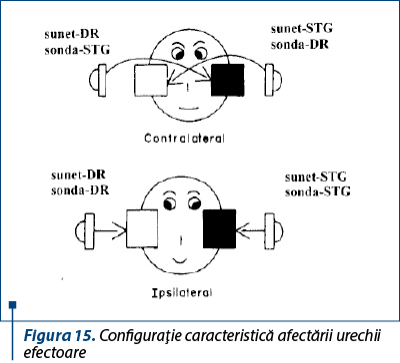 Figura 15. Configuraţie caracteristică afectării urechii efectoare