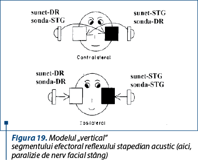Figura 19. Modelul „vertical” caracteristic afectării segmentului efectoral reflexului stapedian acustic (aici, paralizie de nerv facial stâng)