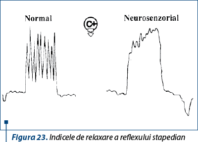 Figura 23. Indicele de relaxare a reflexului stapedian