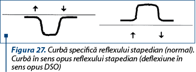 Figura 27. Curbă specifică reflexului stapedian (normal). Curbă în sens opus reflexului stapedian (deflexiune în sens opus DSO)