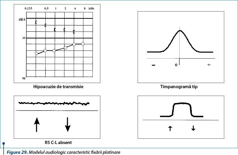 Figura 29. Modelul audiologic caracteristic fixării platinare