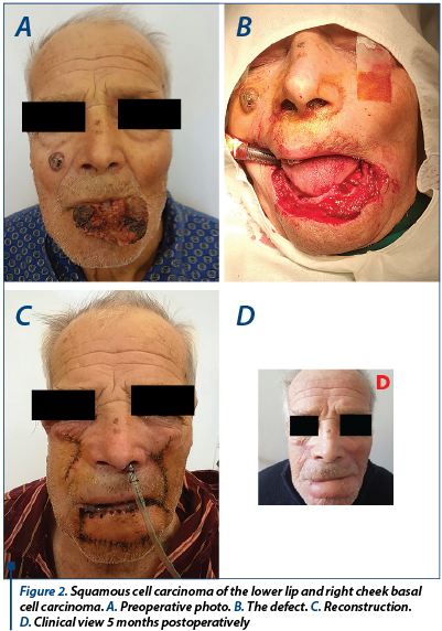 Figure 2. Squamous cell carcinoma of the lower lip and right cheek basal cell carcinoma. A. Preoperative photo. B. The defect. C. Reconstruction.  D. Clinical view 5 months postoperatively