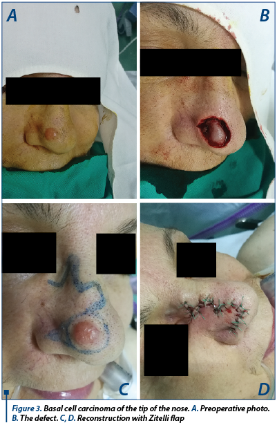 Figure 3. Basal cell carcinoma of the tip of the nose. A. Preoperative photo. B. The defect. C, D. Reconstruction with Zitelli flap