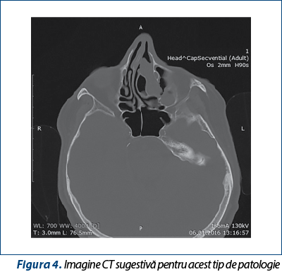 Figura 4. Imagine CT sugestivă pentru acest tip de patologie