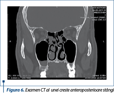 Figura 6. Examen CT al  unei creste anteroposterioare stângi