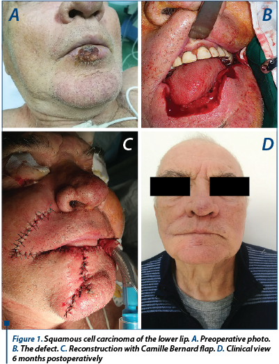 Figure 1. Squamous cell carcinoma of the lower lip. A. Preoperative photo. B. The defect. C. Reconstruction with Camille Bernard flap. D. Clinical view  6 months postoperatively