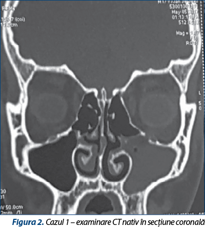 Figura 2. Cazul 1 – examinare CT nativ în secţiune coronală
