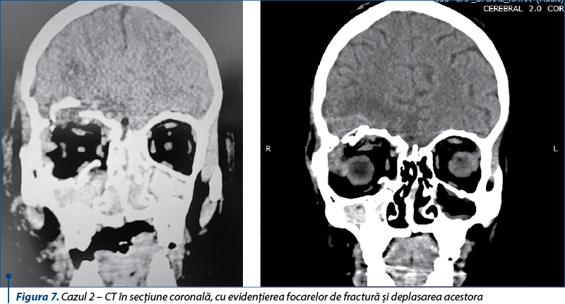Figura 7. Cazul 2 – CT în secţiune coronală, cu evidenţierea focarelor de fractură şi deplasarea acestora