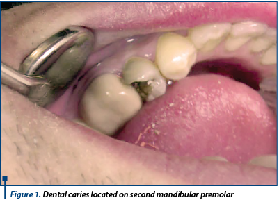 Figure 1. Dental caries located on second mandibular premolar