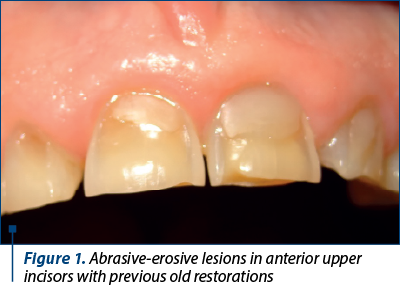 Figure 1. Abrasive-erosive lesions in anterior upper incisors with previous old restorations
