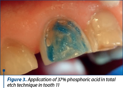 Figure 3. Application of 37% phosphoric acid in total etch technique in tooth 11