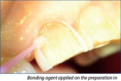 Figure 4. Bonding agent applied on the preparation in tooth 11