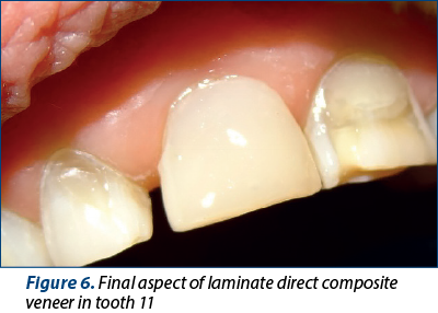 Figure 6. Final aspect of laminate direct composite veneer in tooth 11