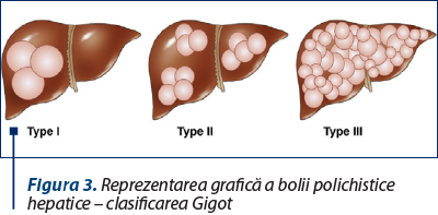 Figura 3. Reprezentarea grafică a bolii polichistice hepatice – clasificarea Gigot
