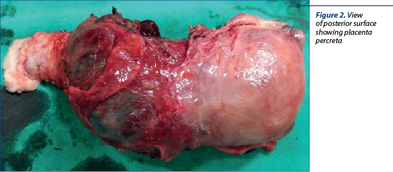Figure 2. View  of posterior surface showing placenta percreta