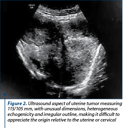 Figure 2. Ultrasound aspect of uterine tumor measuring 115/105 mm, with unusual dimensions, heterogeneous echogenicity and irregular outline, making it difficult to appreciate the origin relative to the uterine or cervical cavity