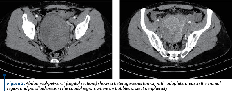 Figure 3. Abdominal-pelvic CT (sagital sections) shows a heterogeneous tumor, with iodophilic areas in the cranial region and parafluid areas in the caudal region, where air bubbles project peripherally