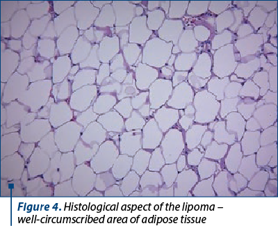 Figure 4. Histological aspect of the lipoma –  well-circumscribed area of adipose tissue 