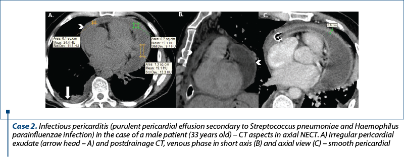 Case 2. Infectious pericarditis (purulent pericardial effusion secondary to Streptococcus pneumoniae and Haemophilus parainfluenzae infection) in the case of a male patient (33 years old) – CT aspects in axial NECT. A) Irregular pericardial exudate (arrow head – A) and postdrainage CT, venous phase in short axis (B) and axial view (C) – smooth pericardial thickening (C) and marked pericardial enhancement