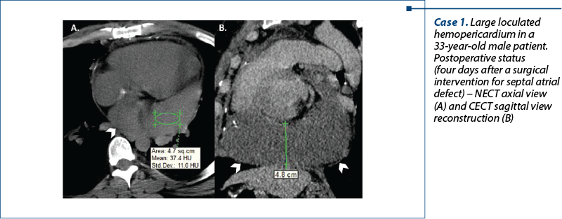 Case 1. Large loculated hemopericardium in a 33-year-old male patient. Postoperative status (four days after a surgical intervention for septal atrial defect) – NECT axial view (A) and CECT sagittal view reconstruction (B)