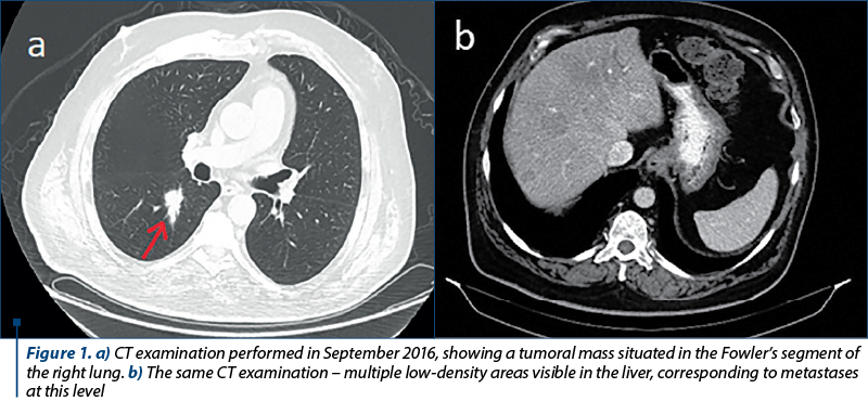 Figure 1. a) CT examination performed in September 2016, showing a tumoral mass situated in the Fowler’s segment of the right lung. b) The same CT examination – multiple low-density areas visible in the liver, corresponding to metastases at this level