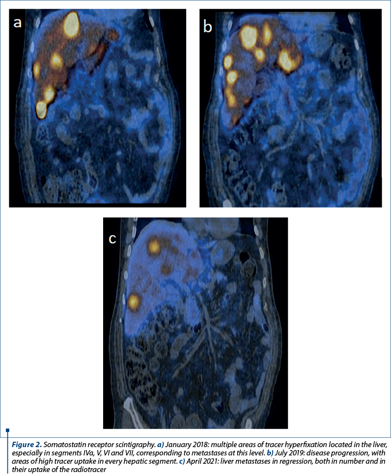 Figure 2. Somatostatin receptor scintigraphy. a) January 2018: multiple areas of tracer hyperfixation located in the liver, especially in segments IVa, V, VI and VII, corresponding to metastases at this level. b) July 2019: disease progression, with areas of high tracer uptake in every hepatic segment. c) April 2021: liver metastases in regression, both in number and in their uptake of the radiotracer