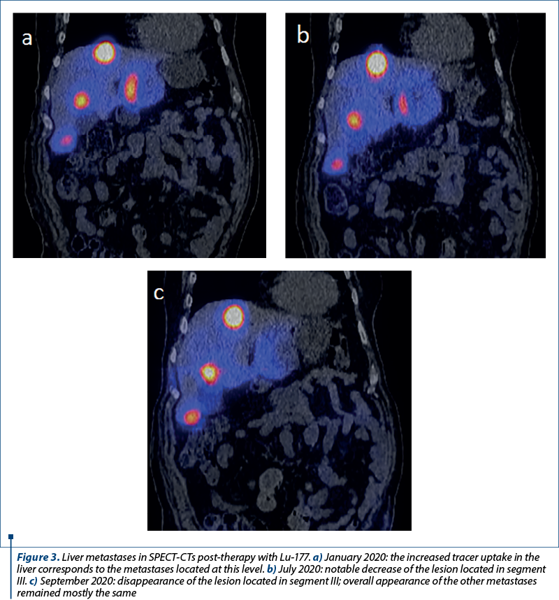 Figure 3. Liver metastases in SPECT-CTs post-therapy with Lu-177. a) January 2020: the increased tracer uptake in the liver corresponds to the metastases located at this level. b) July 2020: notable decrease of the lesion located in segment III. c) September 2020: disappearance of the lesion located in segment III; overall appearance of the other metastases remained mostly the same