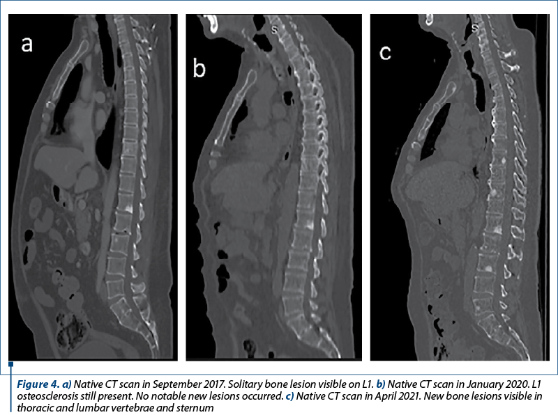 Figure 4. a) Native CT scan in September 2017. Solitary bone lesion visible on L1. b) Native CT scan in January 2020. L1 osteosclerosis still present. No notable new lesions occurred. c) Native CT scan in April 2021. New bone lesions visible in thoracic and lumbar vertebrae and sternum