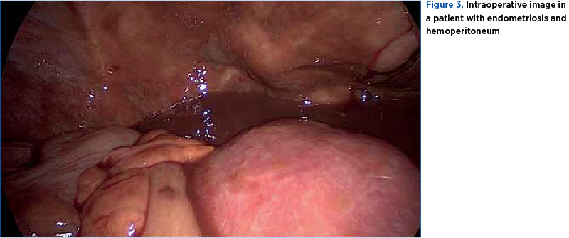 Figure 3. Intraoperative image in a patient with endometriosis and hemoperitoneum