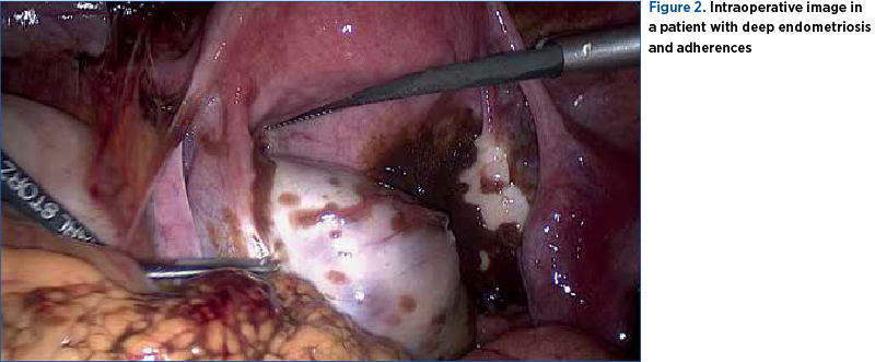 Figure 2. Intraoperative image in a patient with deep endometriosis and adherences
