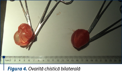Figura 4. Ovarită chistică bilaterală