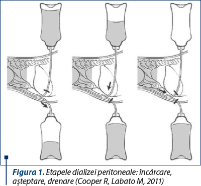 Figura 1. Etapele dializei peritoneale: încărcare, aşteptare, drenare (Cooper R, Labato M, 2011)
