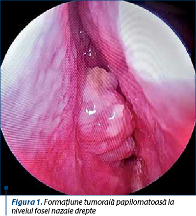 Figura 1. Formaţiune tumorală papilomatoasă la nivelul fosei nazale drepte 