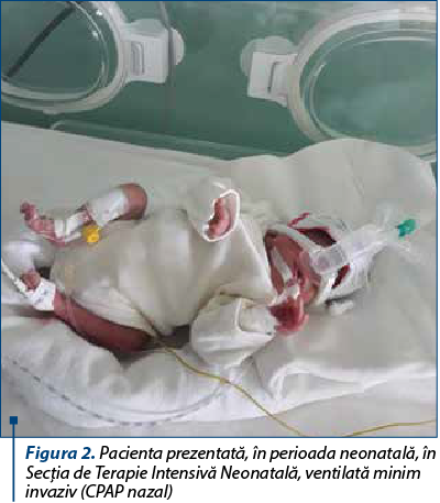 Figura 2. Pacienta prezentată, în perioada neonatală, în Secţia de Terapie Intensivă Neonatală, ventilată minim invaziv (CPAP nazal)