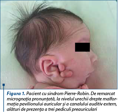 Figura 1. Pacient cu sindrom Pierre-Robin. De remarcat micrognaţia pronunţată, la nivelul urechii drepte mal­for­ma­ţia pavilionului auricular şi a canalului auditiv extern, alături de prezenţa a trei pediculi preauriculari