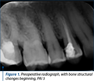 Figure 1. Preoperative radiograph, with bone structural changes beginning, PAI 3
