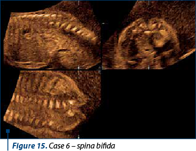 Figure 15. Case 6 – spina bifida