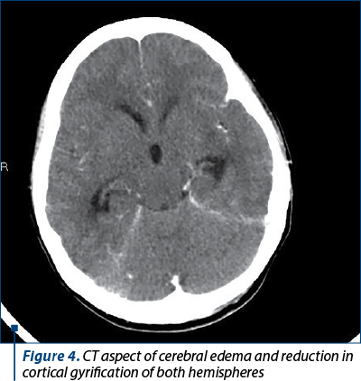 Figure 4. CT aspect of cerebral edema and reduction in cortical gyrification of both hemispheres 