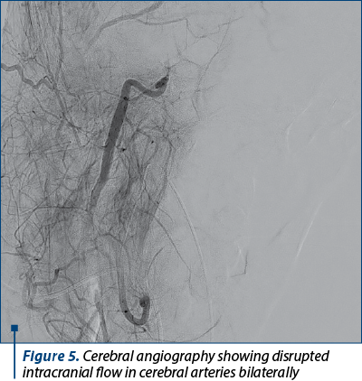 Figure 5. Cerebral angiography showing disrupted intracranial flow in cerebral arteries bilaterally